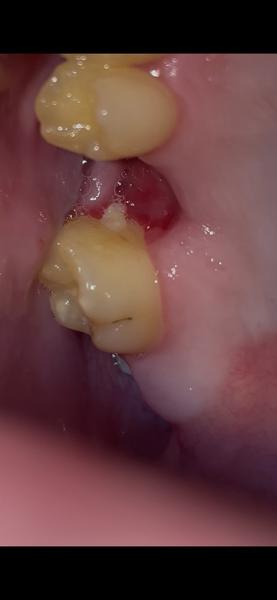 Bolesť po extrakcii horného zuba