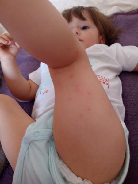 Čo sú toto za vyrážky u mojej dcérky?