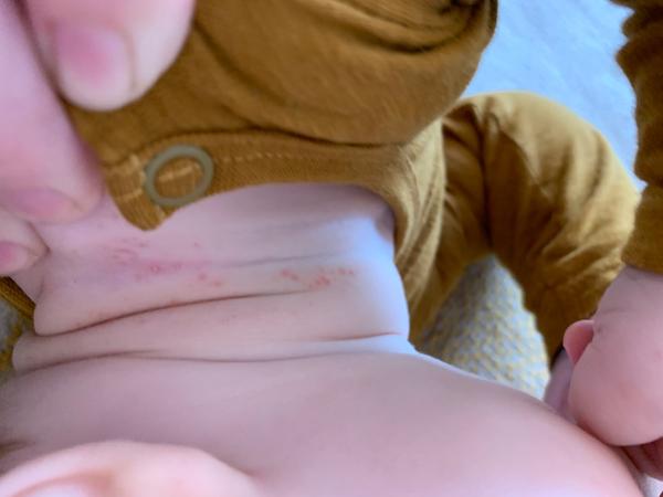 Aké červené fľaky má môj 9 mesačný synček v záhyboch?