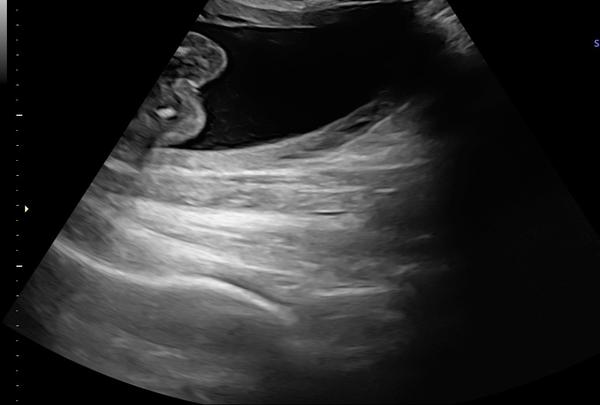 Aké pohlavie dieťatka vidíte na fotke z ultrazvuku?