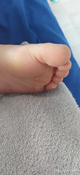 Má môj synček na nohách pleseň?