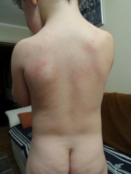 Atopický ekzém u skoro trojročného