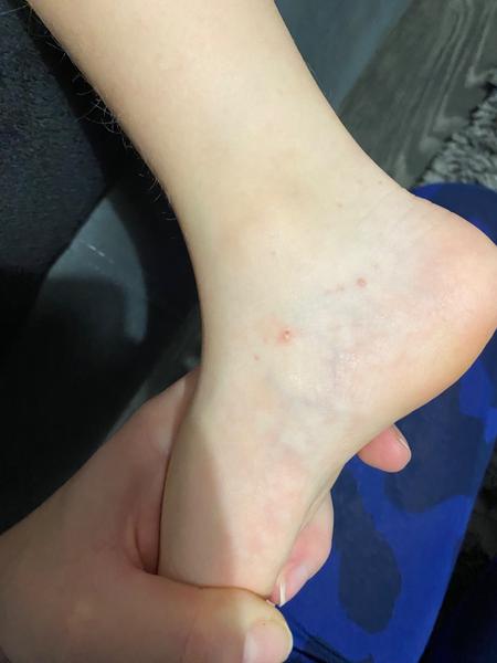 Je svrbenie a vyrážky u detí alergia či svrab?