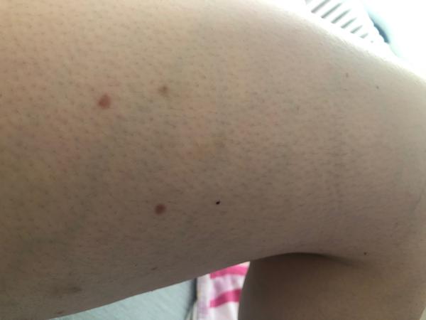 Výsyp na celom tele