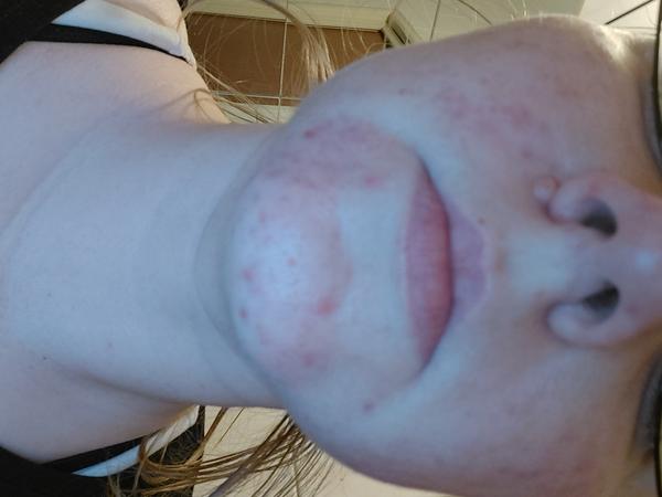 Je to rosacea?