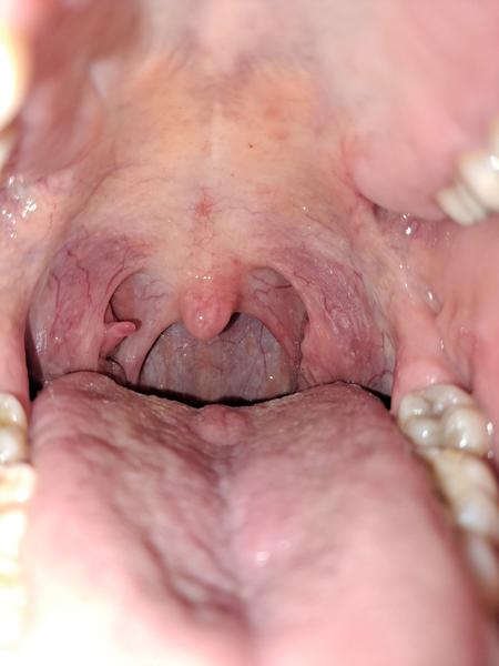 Z čoho sa mi vytvoril výrastok pri mandli?