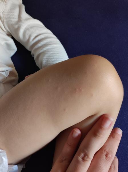 Pupáčiky na nohe dcéry