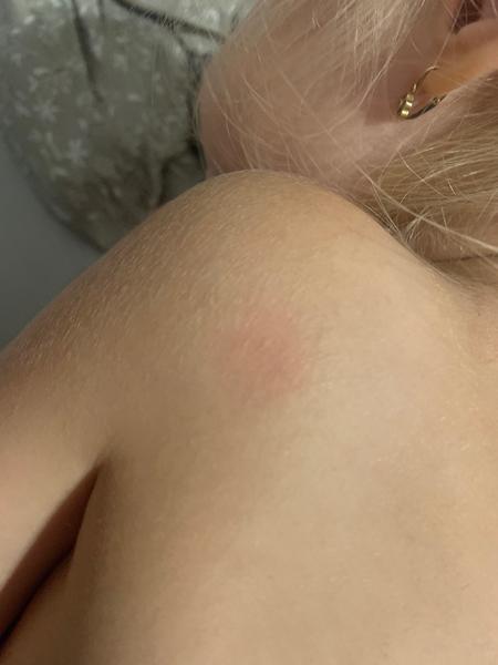 Vyrážky u trojročnej dcérky