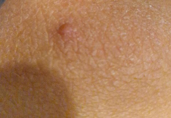 Čo to mám za výrastok na nohe?