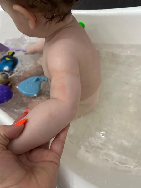 Kožný lišaj u 11-mesačného bábätka: Čo použiť?