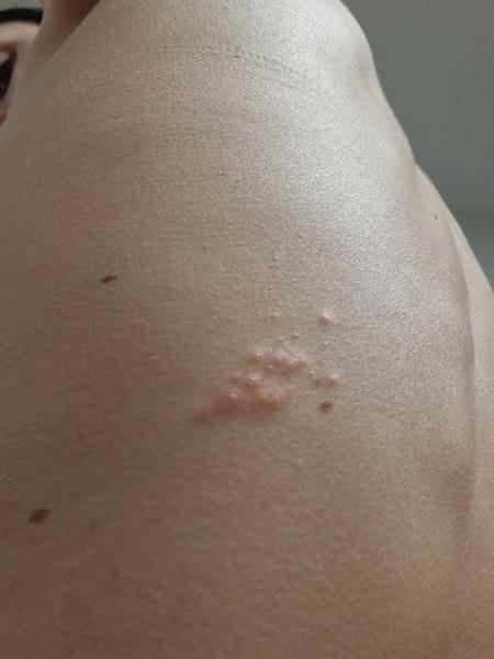 Je to pásový opar?