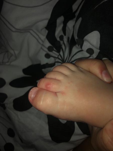 Má dieťa kiahne alebo reakciu na antibiotiká?