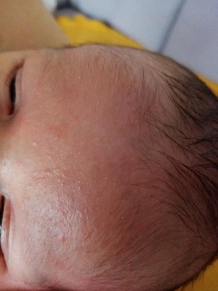 Čo to má moje novorodeniatko na tváričke?