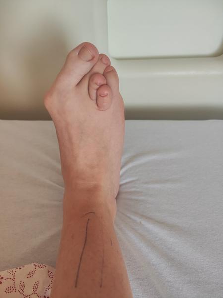 Bude vyberanie drôtov po operácii bolestivé?