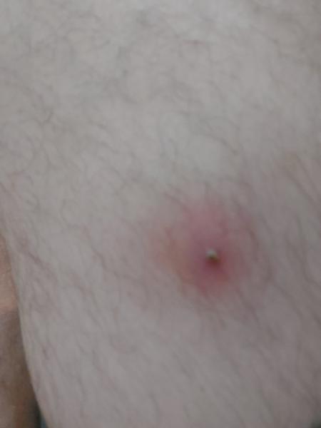 Mám navštíviť lekára s abscesom na nohe?