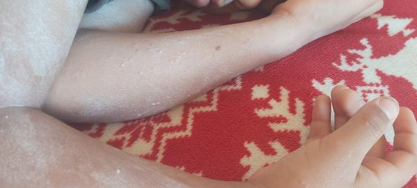 Ako riešiť vyrážku u dieťaťa?