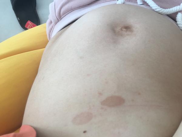 Fľaky na bruchu v tehotenstve