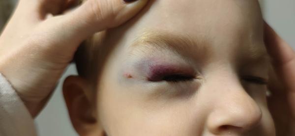 Monokel u trojročného dieťaťa