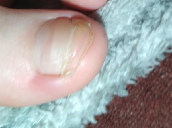 Udrela som si prst a odpadol mi necht