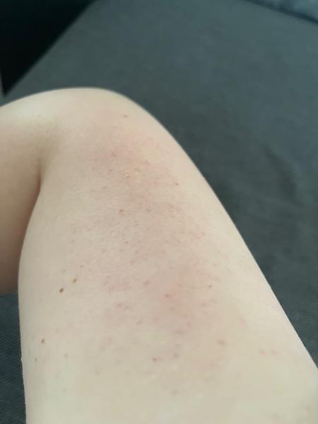 Červené vyrážky na ramenách a nohách