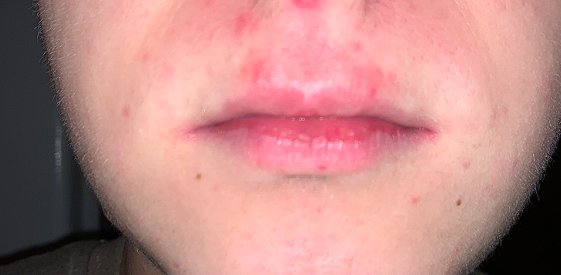 Vyrážky nad perou u 16-ročného