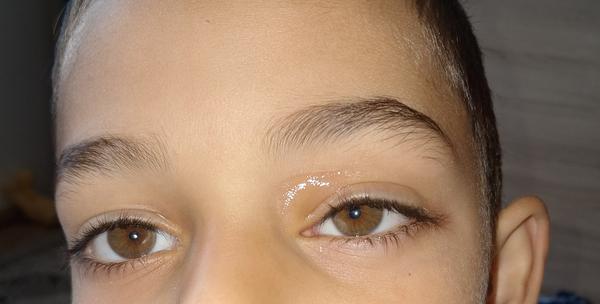 Čo môže byť príčinou problému s okom u syna?