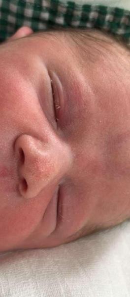 Červené znamienka u novorodencov