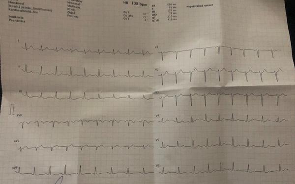 Je moje EKG v poriadku?
