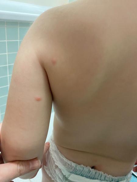 Z čoho sa 20-mesačnému synovi vytvorili takéto vyrážky?