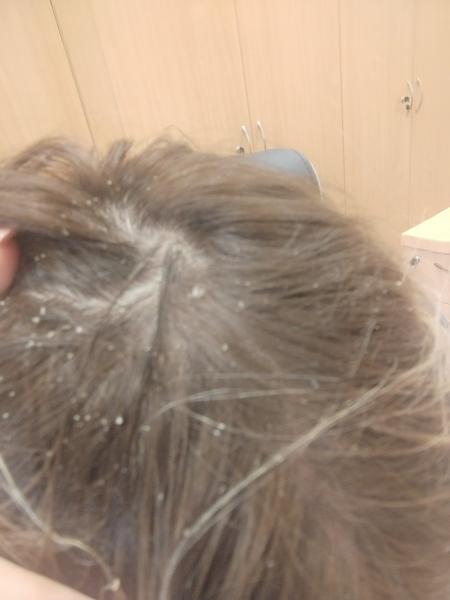 Veľké lupiny len na vrchu hlavy