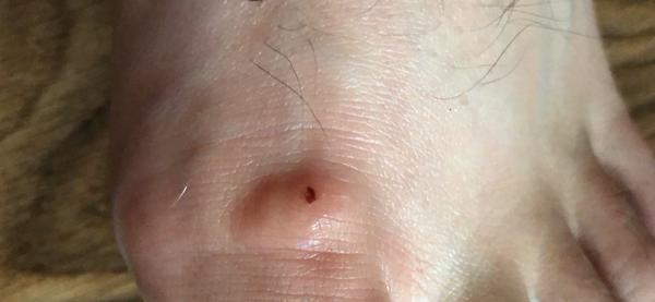 Kožný problém na nohe - čo je to?