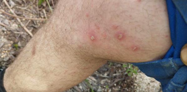 Čo spôsobuje bolesť a hnisavé vyrážky na stehnách?