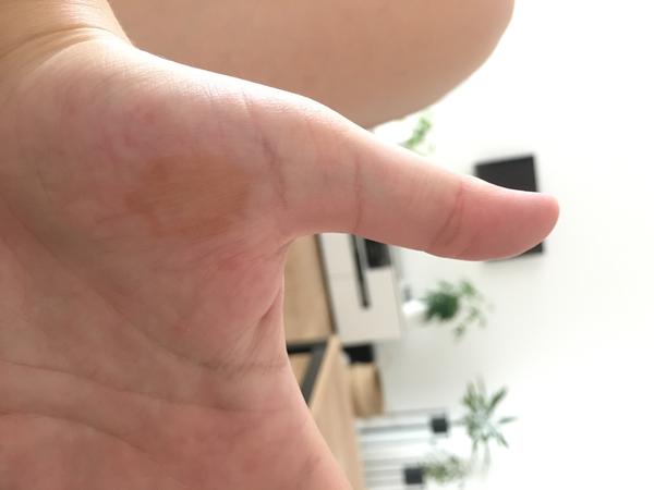 Aký fľak mám na dlani?