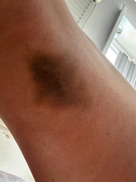 Čo môže spôsobovať modriny z ničoho nič?