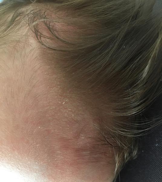 Suché čielko u drobčeka