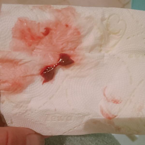 Zhluk krvi vo výtoku v 36. týždni