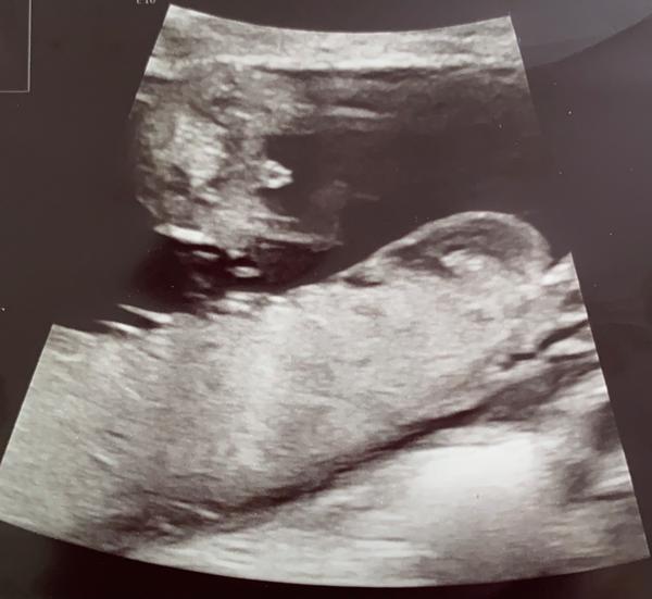 Čakám chlapčeka alebo dievčatko?