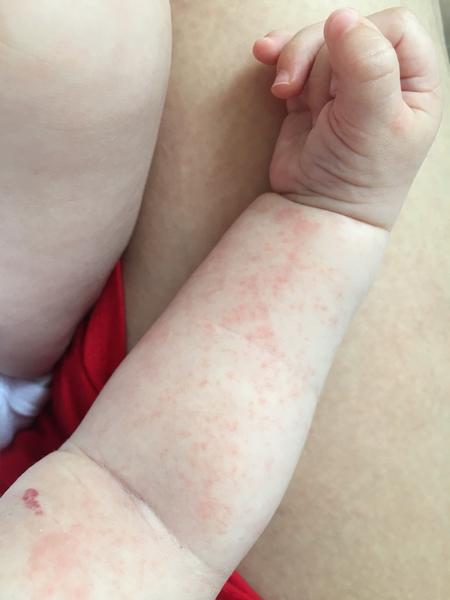 Čo znamenajú tieto vyrážky na ručičke 5 mesačného syna?