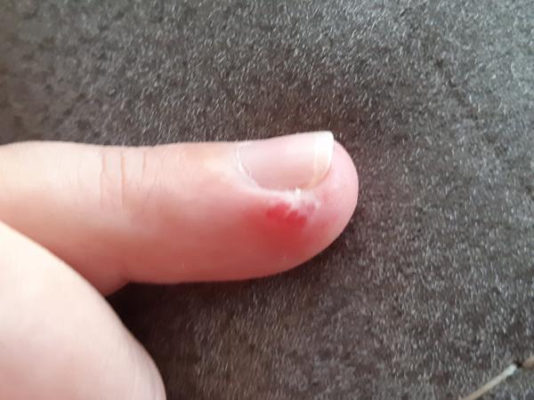 Ako liečiť lymfangióm počas tehotenstva?