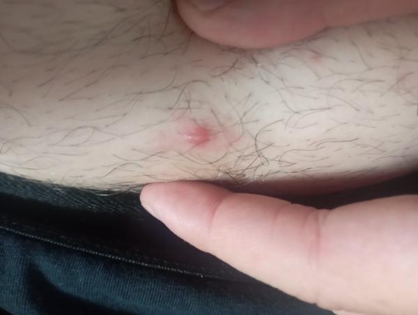 Čo je toto za vyrážku?