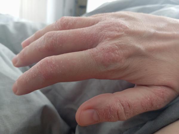 Aké sú tradičné metódy liečby chronického ekzému?