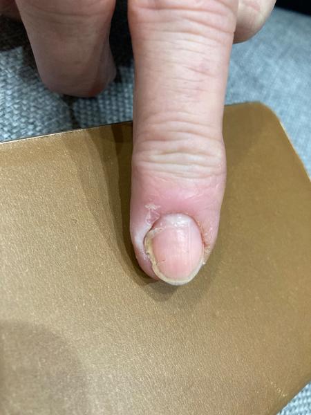 Ako riešiť zapálené lôžko a poškodenie nechtu?