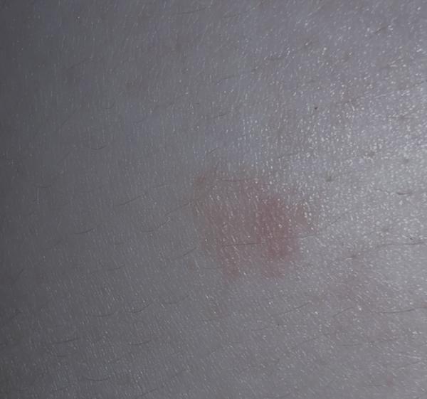 Fľak, ktorý nebolí a ani nesvrbí