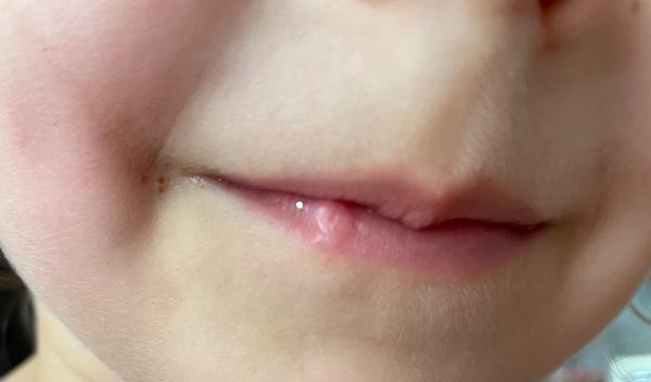 Ako znížiť viditeľnosť jazvy na pere u dieťaťa?