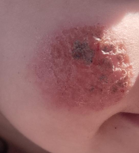 Kožný problém u dieťaťa