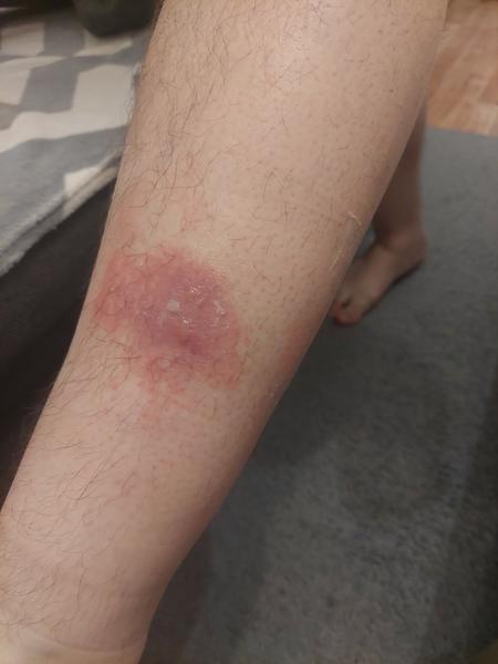 Manželovi sa tvoria červené fľaky