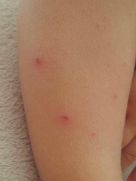 Aké vyrážky po tele má môj 21-mesačný synček?