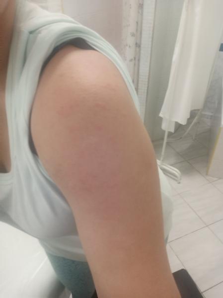 Môžu vyrážky súvisieť s užívaním Egiloku?