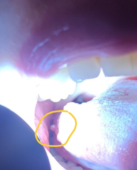 Čo to môže byť na jazyku?