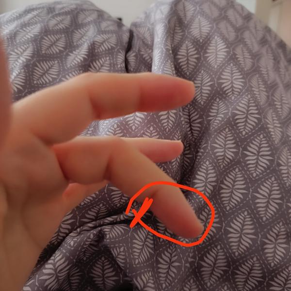 Neschopnosť ohnúť prst s bolesťou a mravčením v ruke